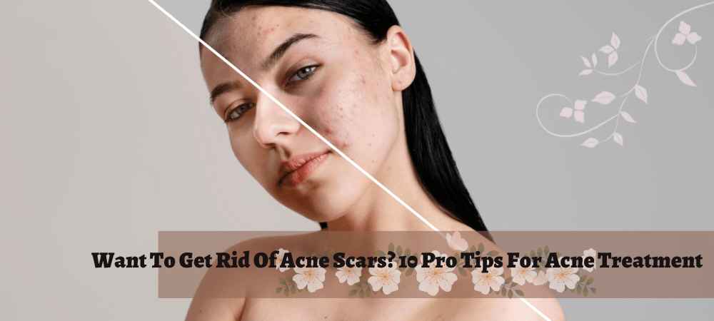 Want To Get Rid Of Acne Scars 10 Pro Tips For Acne Treatment-min_11zon