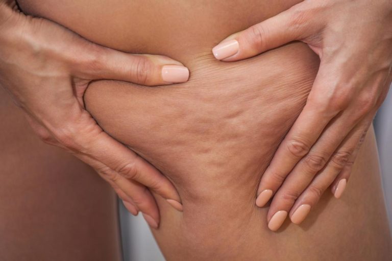 Want to Try CoolSculpting Cellulite? Read This First