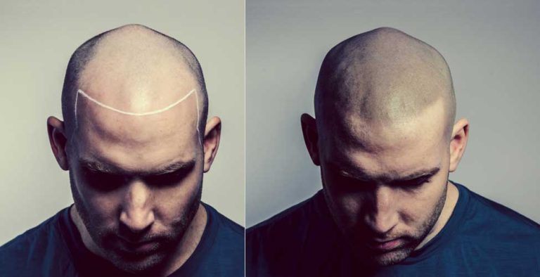 Things You Need To Know About Scalp Micropigmentation