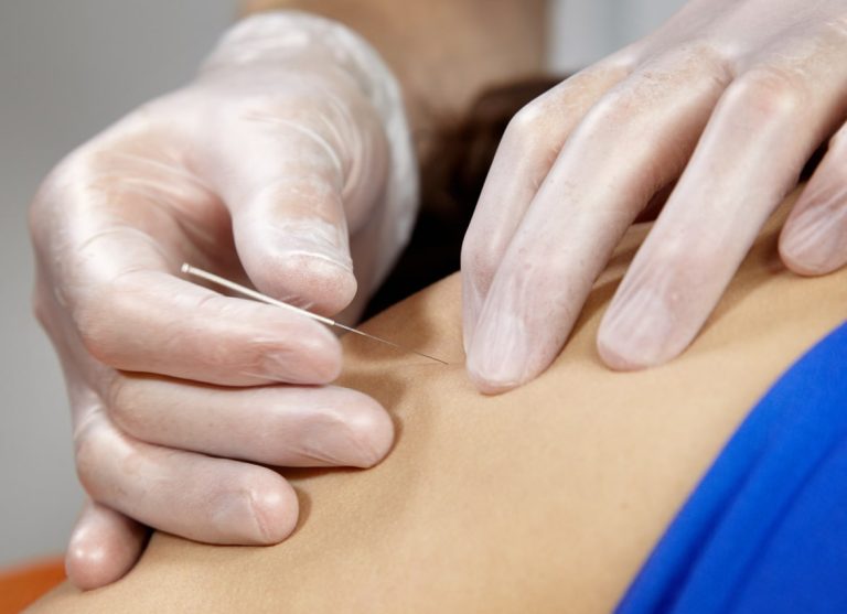 Dry Needling: A Safe and Effective Therapy for Pain Relief and Improved Function