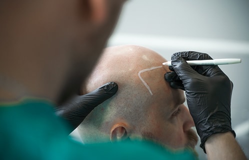 Everything You Ever Wanted To Know About Scalp Micropigmentation