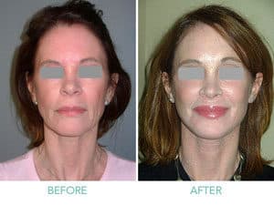Get Younger Looking Appearance With FaceLift Treatment