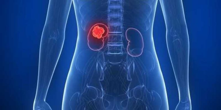 What Increases The Risk of Kidney Cancer?
