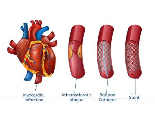 What Happens When You Get an Angiography?