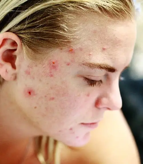 Do Chemical Peel Treatment Works For Acne?