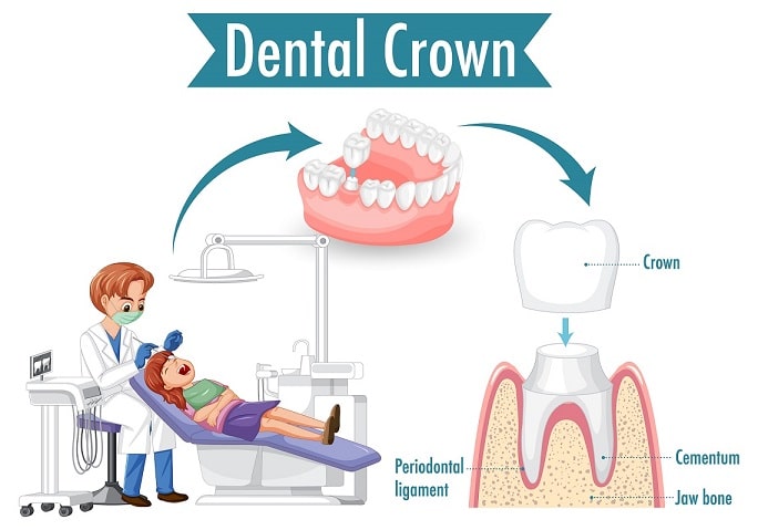 Dental Crown York