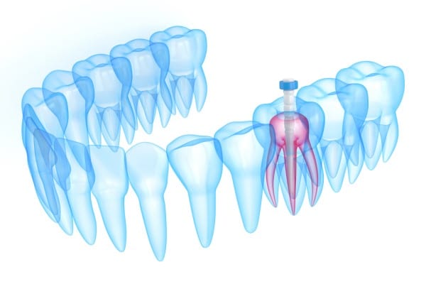 Root canal in Madurai