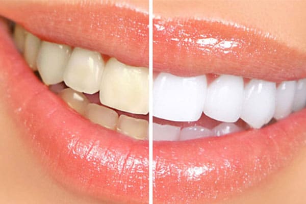 Smile Dental Teeth Whitening