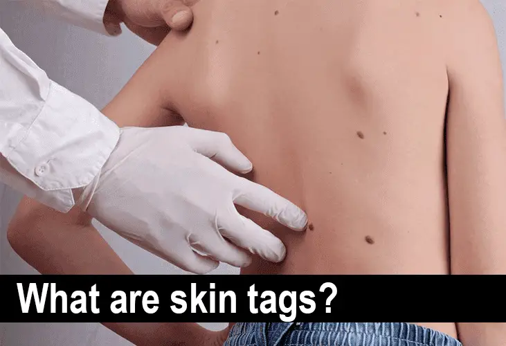 What are skin tags?