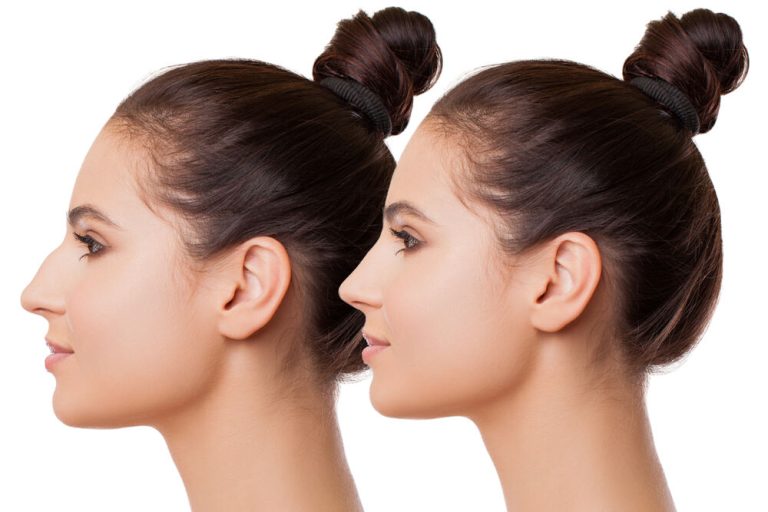 Botox for the nose vs. rhinoplasty – Which is better for me?