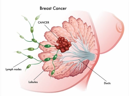 Study on PDX Model of Human Breast Cancer