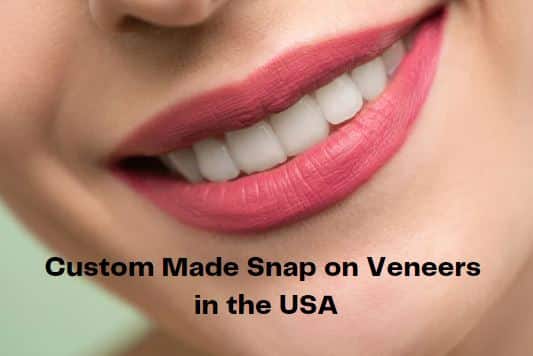 custom made snap on veneers