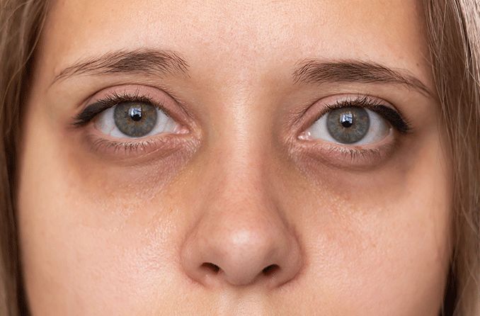 Say Goodbye to Dark Circles: Effective Remedies for Under-Eye Bags and Shadows