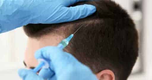 Best Hair Transplant in Delhi