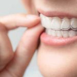 invisalign-treatment-gallery-1