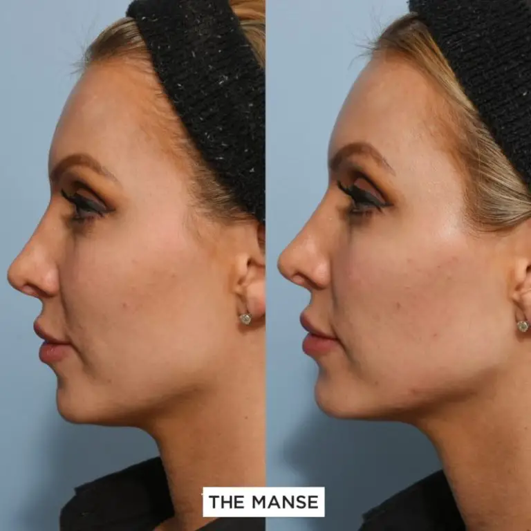 Enhance Your Jawline with Non-Surgical Jawline Filler Treatment