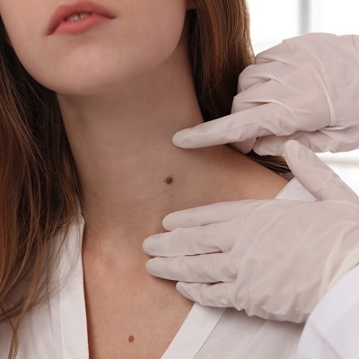 Safely Removing Moles: Understanding the Process and Benefits of Mole Removal