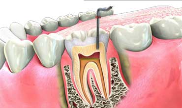 Root Canal Treatment