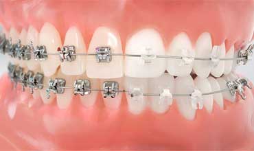 teeth-alignments