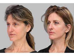 Enhancing Your Jawline with Hyaluronic Acid Fillers: A Guide to Achieving a More Defined and Youthful Appearance