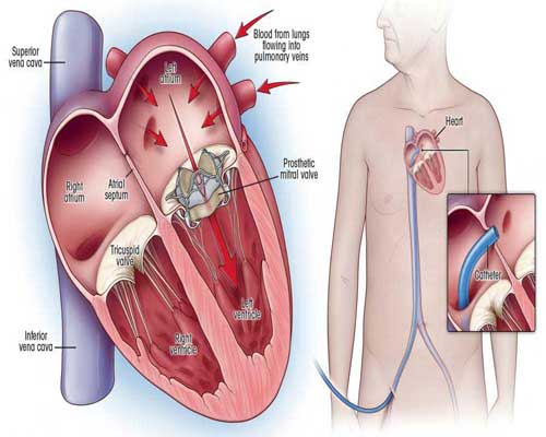 Debunking the Myths About Cardiac Surgery