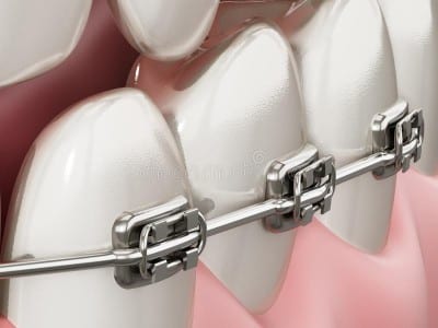 Taking Care of the Braces: A Few Tips