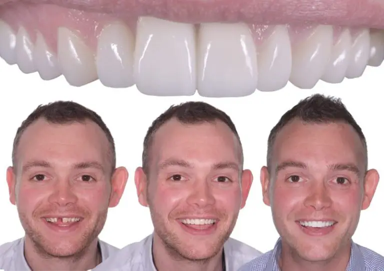 How You Will Look After Your Dental Implants?