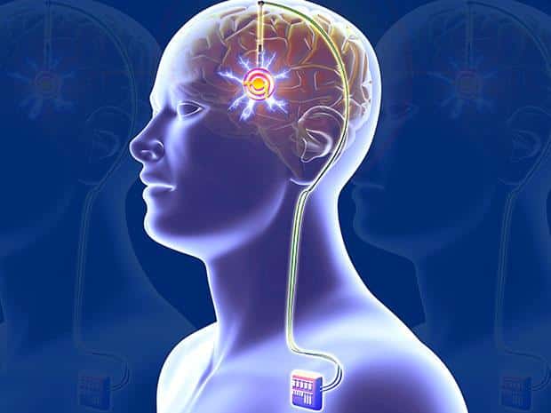 Non-invasive Brain Stimulation System Market