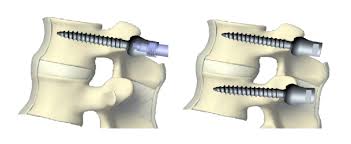 Pedicle screw system market