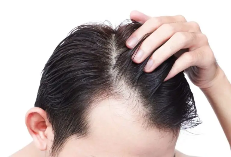 How To Find The Best Doctor For Hair Transplant in Jaipur?