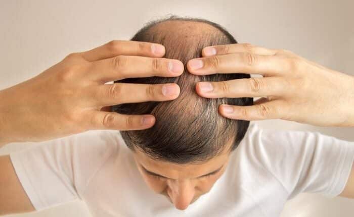 How Much Is The Cost of Hair Transplant In Hyderabad?
