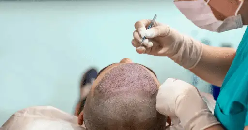 Hair Transplant Surgery’s Financial Viability: Is it a Worthy Investment?