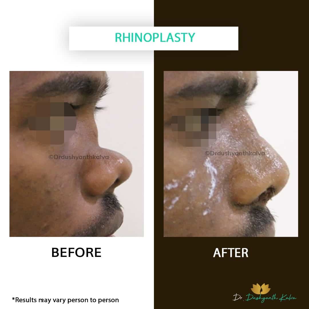 Rrhinoplasty doctor in Hyderabad