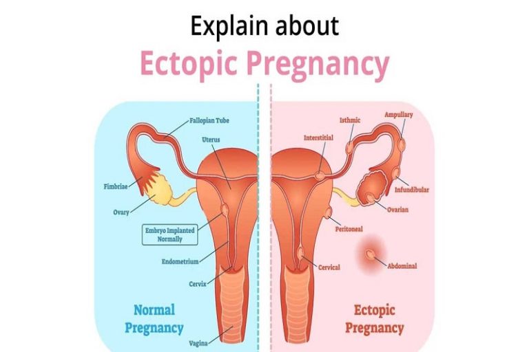 Ectopic Pregnancy: What are the symptoms and treatment process?