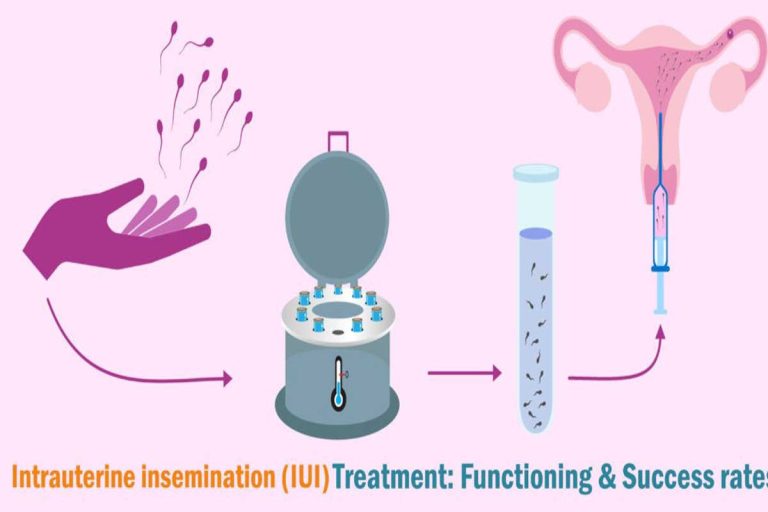 Exploring IUI Treatment Cost – What to Expect and How to Plan