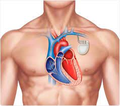 Cardiac Pacemaker Market Report, Share, Size and Forecast 2023-2028