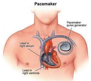 Pacemaker Market