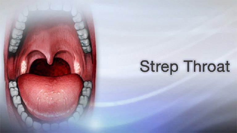 Exploring the Possibility of Strep Throat Without Tonsils