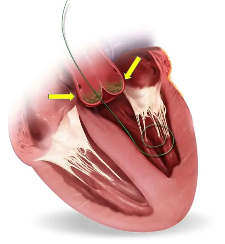 Transcatheter Aortic Valve Implantation Market Share, Trend, Growth, and Forecast