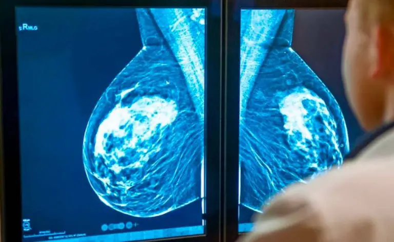 Navigating Breast Health: When to Start Having Mammograms?