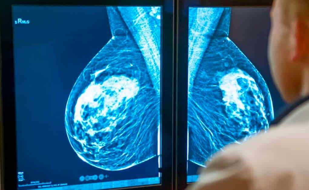 When to Start Having Mammograms