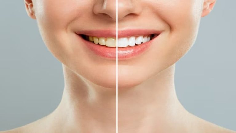 Finding Relief: Gum Recession Surgery Options in San Ramon, CA