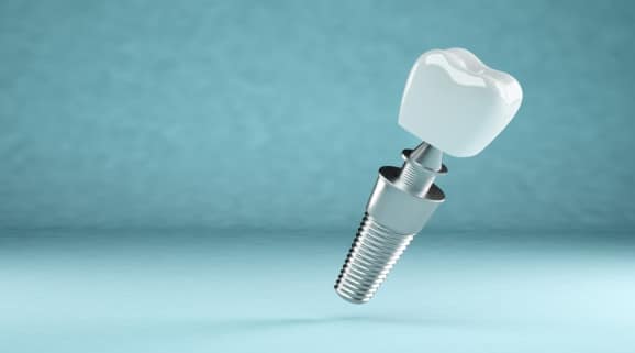 Revolutionizing Smiles: Mini Implants Sparking Dental Transformation in Hot Springs, AR