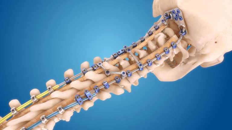 Spinal Surgery Products Market Analysis, Challenges, Growth and Forecast By 2030