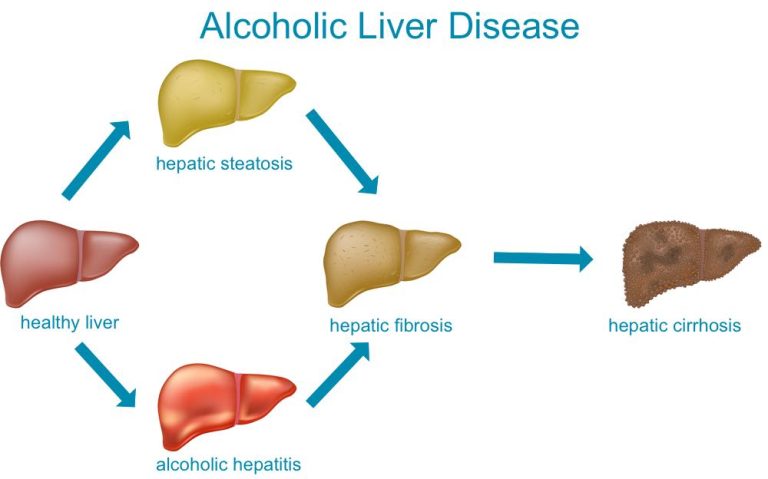 A Comprehensive Analysis of Alcoholic Hepatitis Treatment Market (2023-2033)