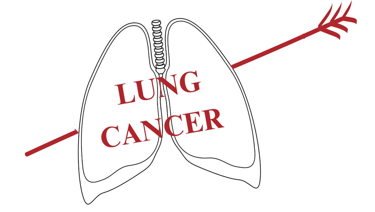 Study-Finds-UDPG-promising-target-for-lung-cancer-metastasis-detection-and-Treatment