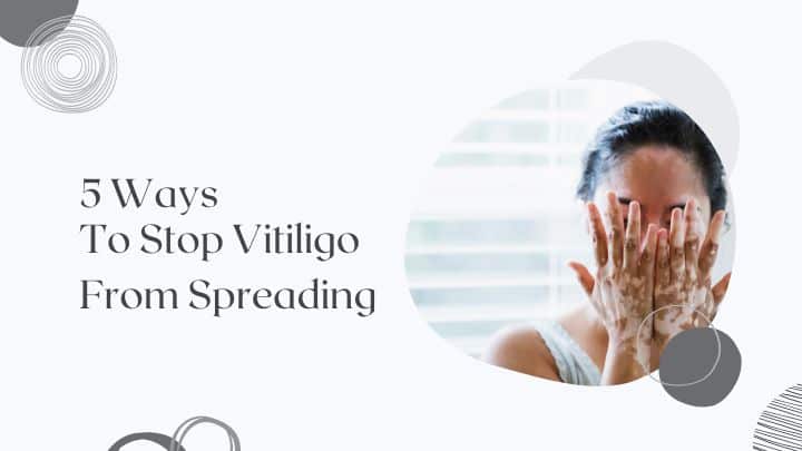 5 Ways To Stop Vitiligo From Spreading