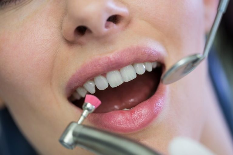 Facts You Need to Know About Dental Implants