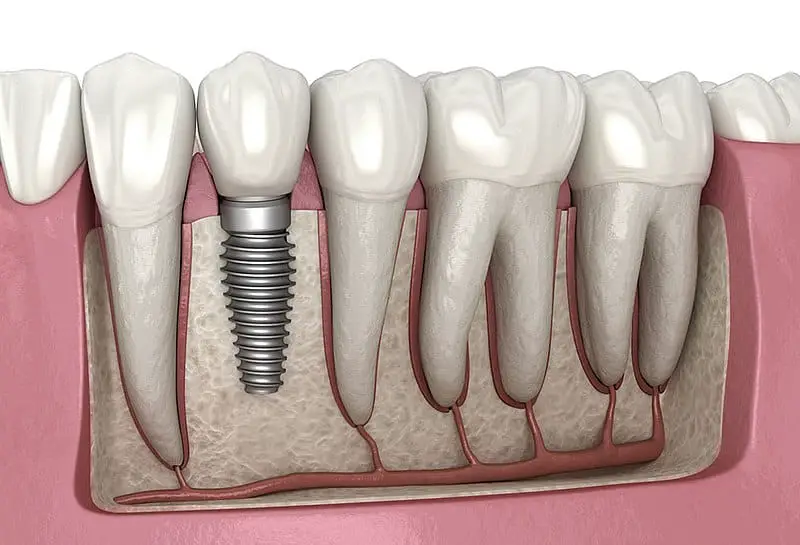 Dental implants1