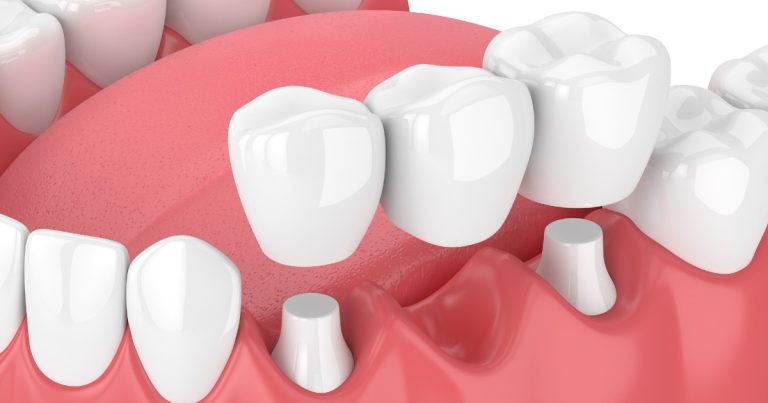 Dental Implants in Burlington: The Ultimate Guide to Restoring Your Smile